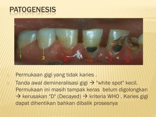 PATOGENESIS
1. Permukaan gigi yang tidak karies .
2. Tanda awal demineralisasi gigi  "white spot" kecil.
Permukaan ini masih tampak keras belum digolongkan
 kerusakan "D" (Decayed)  kriteria WHO . Karies gigi
dapat dihentikan bahkan dibalik prosesnya
 