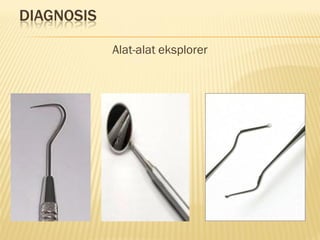 DIAGNOSIS
Alat-alat eksplorer
 