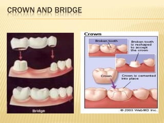 CROWN AND BRIDGE
 