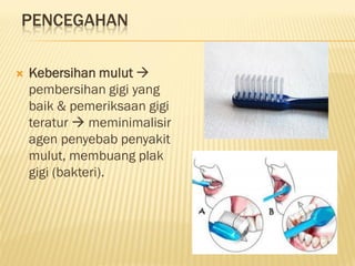 PENCEGAHAN
 Kebersihan mulut 
pembersihan gigi yang
baik & pemeriksaan gigi
teratur  meminimalisir
agen penyebab penyakit
mulut, membuang plak
gigi (bakteri).
 