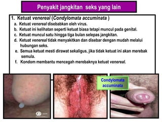 Penyakit jangkitan seks yang lain
1. Ketuat venereal (Condylomata accuminata )
a. Ketuat venereal disebabkan oleh virus.
b. Ketuat ini kelihatan seperti ketuat biasa tetapi muncul pada genital.
c. Ketuat muncul satu hingga tiga bulan selepas jangkitan.
d. Ketuat venereal tidak menyakitkan dan disebar dengan mudah melalui
hubungan seks.
e. Semua ketuat mesti dirawat sekaligus, jika tidak ketuat ini akan merebak
semula.
f. Kondom membantu mencegah merebaknya ketuat venereal.
Condylomata
accuminata
 