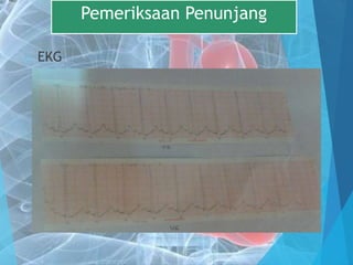  EKG
Pemeriksaan Penunjang
 