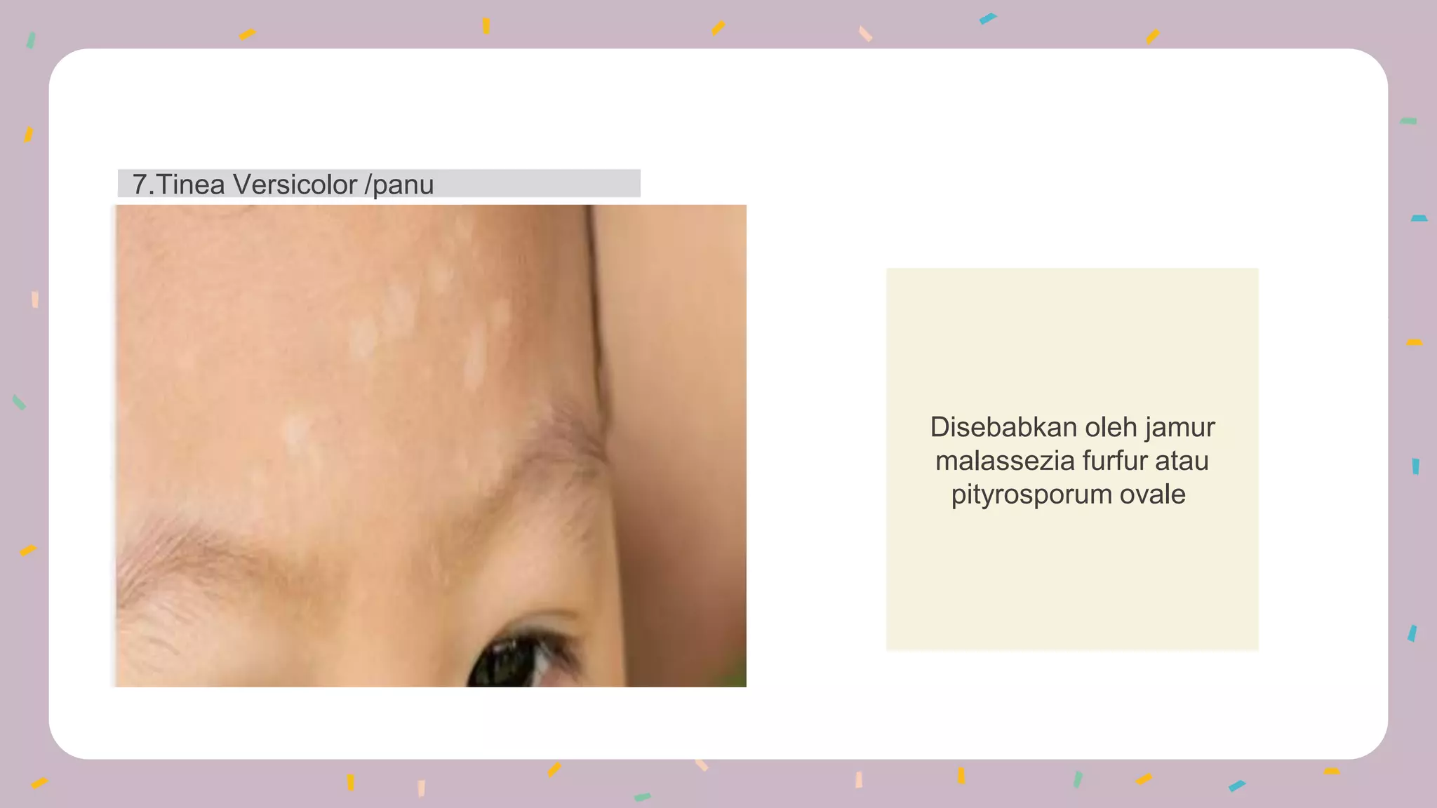 Disebabkan oleh jamur
malassezia furfur atau
pityrosporum ovale.
7.Tinea Versicolor /panu