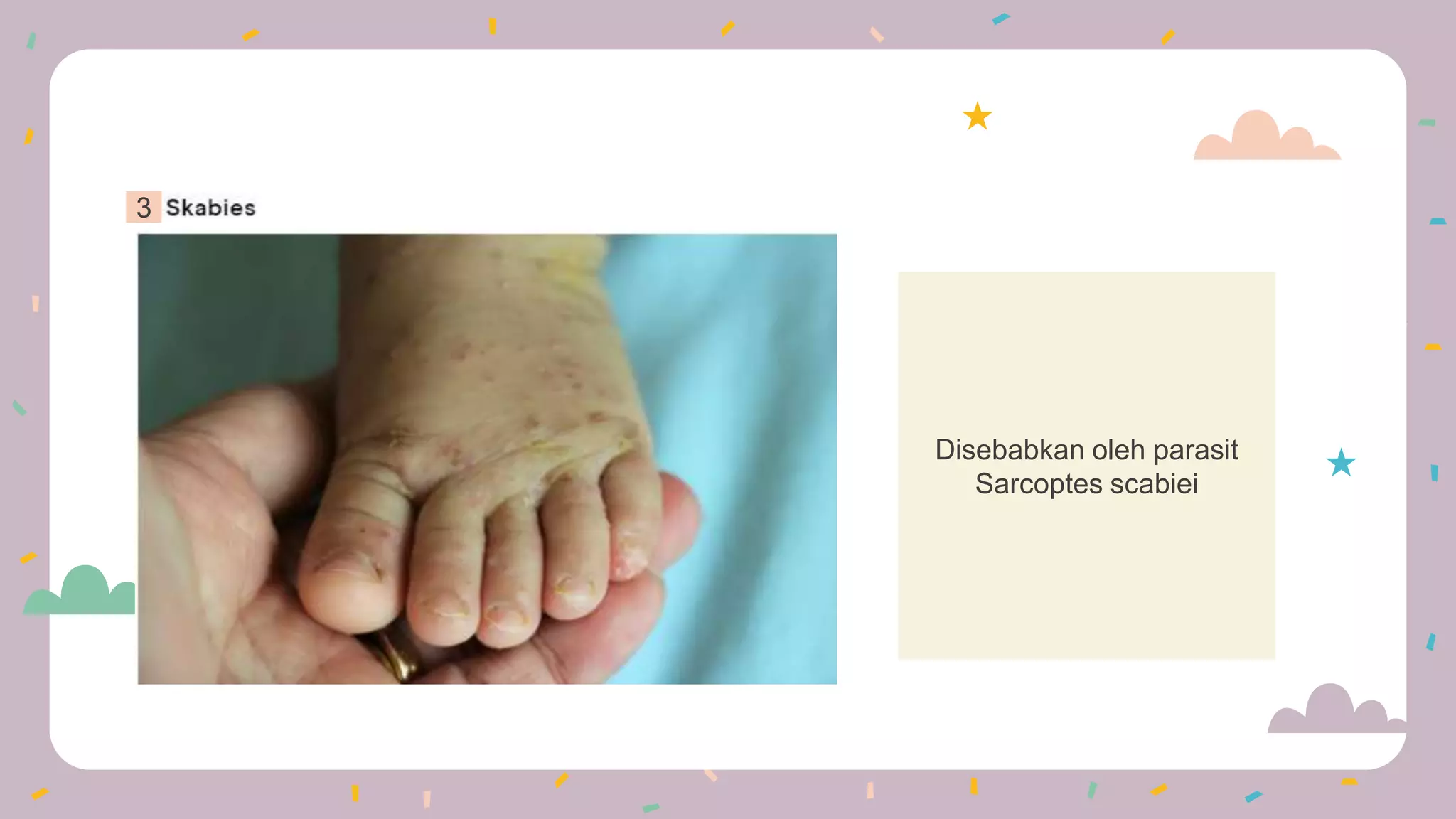 Disebabkan oleh parasit
Sarcoptes scabiei
3