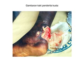 Gambaran kaki penderita kusta
 