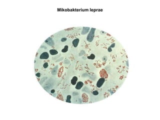 Mikobakterium leprae
 