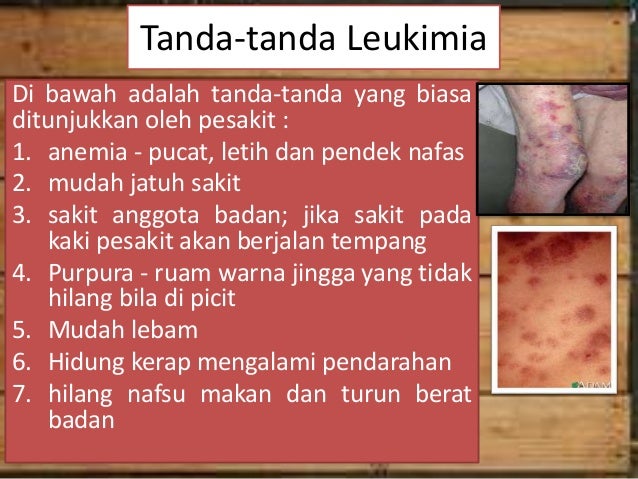 Penyakit Leukimia