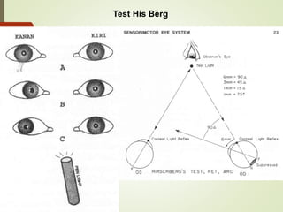 Hberg Test Penyakit mata anak | PPTX