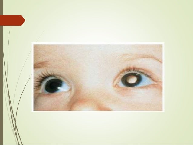 Penyakit mata anak