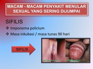 MACAM - MACAM PENYAKIT MENULAR
SEXUAL YANG SERING DIJUMPAI
SIFILIS
 treponema policlum
 Masa inkubasi / masa tunas 90 hari
SIFILIS
 