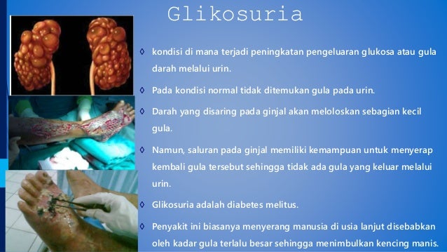 Penyakit pada ginjal Albuminuria Anuria Glikosaria dan sbg 