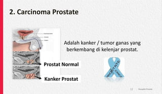 2. Carcinoma Prostate
Penyakit Prostat
12
Adalah kanker / tumor ganas yang
berkembang di kelenjar prostat.
Kanker Prostat
Prostat Normal
 