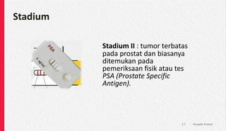 Stadium
Stadium II : tumor terbatas
pada prostat dan biasanya
ditemukan pada
pemeriksaan fisik atau tes
PSA (Prostate Specific
Antigen).
Penyakit Prostat
17
 