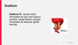 Stadium
Stadium III : tumor telah
menyebar ke luar dari kapsul
prostat, tetapi belum sampai
menyebar ke kelenjar getah
bening.
Penyakit Prostat
18
 