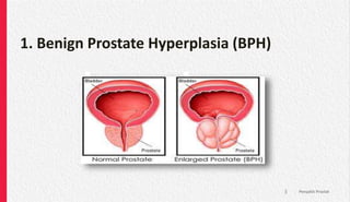 1. Benign Prostate Hyperplasia (BPH)
Penyakit Prostat
3
 