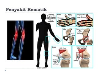 Penyakit Rematik
 