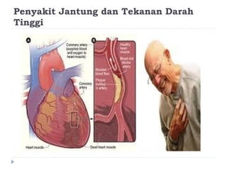 Penyakit Jantung dan Tekanan Darah
Tinggi
 