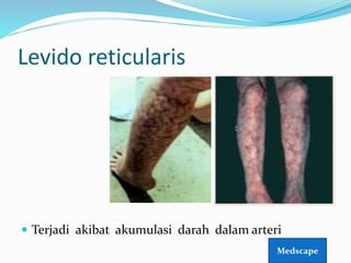 Levido reticularis
 Terjadi akibat akumulasi darah dalam arteri
Medscape
 