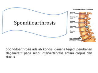 Spondiloarthrosis adalah kondisi dimana terjadi perubahan
degeneratif pada sendi intervertebralis antara corpus dan
diskus.
Spondiloarthrosis
 