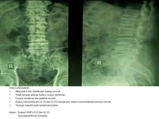 Foto Lumbosakral :
• Allignment dan trabekulasi tulang normal
• Tidak tampak adanya fraktur corpus vertebrae
• Corpus vertebrae dan pedikel normal
• Diskus intervertebralis L4-L5 dan L5-S1 menyempit, diskus intervertebralis lainnya normal.
• Tampak osteofit pada vertebrae lumbal
Kesan : Suspect HNP L4-L5 dan L5-S1
Spondyloarthrosis lumbalis
 