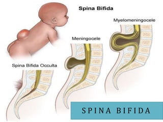 S P I N A B I F I D A
 