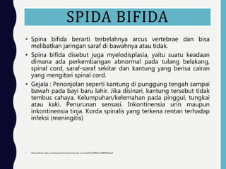 SPIDA BIFIDA
• Spina bifida berarti terbelahnya arcus vertebrae dan bisa
melibatkan jaringan saraf di bawahnya atau tidak.
• Spina bifida disebut juga myelodisplasia, yaitu suatu keadaan
dimana ada perkembangan abnormal pada tulang belakang,
spinal cord, saraf-saraf sekitar dan kantung yang berisa cairan
yang mengitari spinal cord.
• Gejala : Penonjolan seperti kantung di punggung tengah sampai
bawah pada bayi baru lahir. Jika disinari, kantung tersebut tidak
tembus cahaya. Kelumpuhan/kelemahan pada pinggul, tungkai
atau kaki. Penurunan sensasi. Inkontinensia urin maupun
inkontinensia tinja. Korda spinalis yang terkena rentan terhadap
infeksi (meningitis)
• http://elib.fk.uwks.ac.id/asset/archieve/jurnal/vol1.no2.Juli2011/SPINA%20BIFIDA.pdf
 