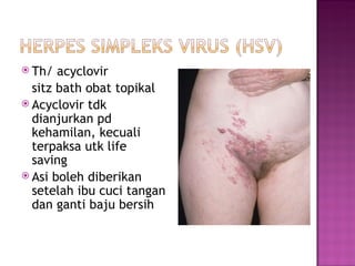 T h/  acyclovir  sitz bath obat topikal Acyclovir tdk dianjurkan pd kehamilan, kecuali terpaksa utk life saving Asi boleh diberikan setelah ibu cuci tangan dan ganti baju bersih 