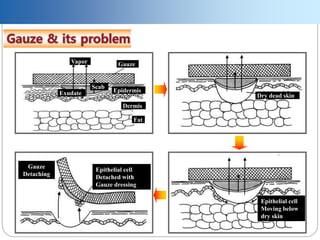 Vapor Gauze
Scab
Exudate Epidermis
Dermis
Fat
Dry dead skin
Gauze
Detaching
Epithelial cell
Detached with
Gauze dressing
Epithelial cell
Moving below
dry skin
 