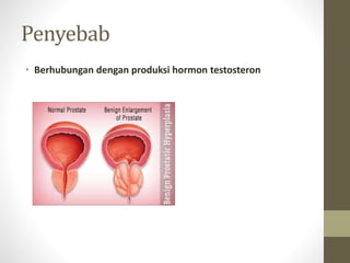 Penyebab
• Berhubungan dengan produksi hormon testosteron
 