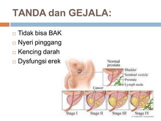 penyuluhan edukasi kanker prostat untuk masyarakat awam | PPTX
