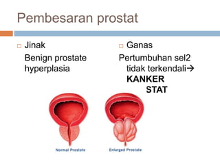Pembesaran prostat
 Jinak
Benign prostate
hyperplasia
 Ganas
Pertumbuhan sel2
tidak terkendali
KANKER
PROSTAT
 