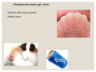 Hilangnya permukaan gigi (erosi)
- Muntah (Morning sickness)
- Makan asam
 
