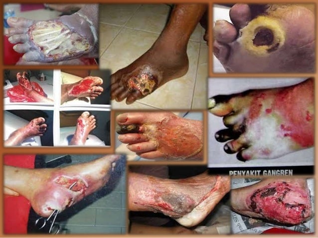 Penyakit diabetes melitus