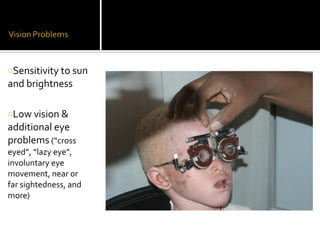 oSensitivity to sun
and brightness

oLow vision &
additional eye
problems (“cross
eyed”, “lazy eye”,
involuntary eye
movem...
