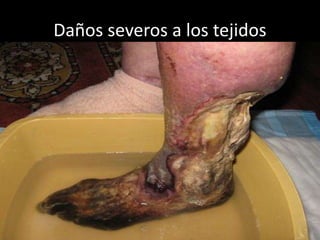 Daños severos a los tejidos
 