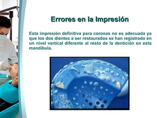 Errores en la Impresión Esta impresión definitiva para coronas no es adecuada ya que los dos dientes a ser restaurados se han registrado en un nivel vertical diferente al resto de la dentición en esta mandíbula.  