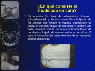 ¿ En qué consiste el modelado en cera? 1. Se enceran los tipos de retenedores directos  (circunferencial  y  de tipo barra). Para la fijación de los dientes que limitan el espacio desdentado se utiliza un conector mayor de tipo barra y también una base protésica colada, se requiere la adaptación de un alambre forjado de sección redonda de calibre 18 para la formación del brazo retentivo de un retenedor directo combinado. 