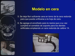 Modelo en cera 5. Se deja fluir suficiente cera en torno de la cera redonda para que pueda unificarse a la hoja de cera. 6. Se agrega el encofrado para la resina que a su vez cumplirá el cometido de soporte para los dientes artificiales empleando un cera redonda de calibre 14. 