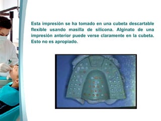 Esta impresión se ha tomado en una cubeta descartable flexible usando masilla de silicona. Alginato de una impresión anterior puede verse claramente en la cubeta. Esto no es apropiado.  
