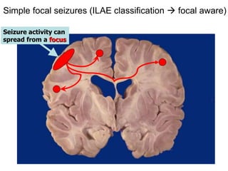 Dr Kelley 10
Seizure activity can
spread from a focus
Simple focal seizures (ILAE classification  focal aware)
 