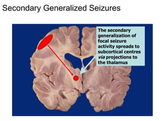 Dr Kelley 15
The secondary
generalization of
focal seizure
activity spreads to
subcortical centres
via projections to
the thalamus
Secondary Generalized Seizures
 