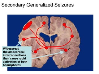 Dr Kelley 16
Secondary Generalized Seizures
Widespread
thalamocortical
interconnections
then cause rapid
activation of both
hemispheres
 