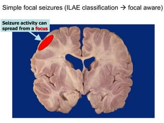 Dr Kelley 9
Simple focal seizures (ILAE classification  focal aware)
Seizure activity can
spread from a focus
 