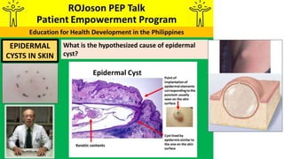 What is the hypothesized cause of epidermal
cyst?
EPIDERMAL
CYSTS IN SKIN
 