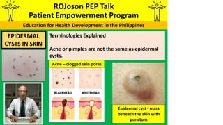 Terminologies Explained
Acne or pimples are not the same as epidermal
cysts.
EPIDERMAL
CYSTS IN SKIN
Epidermal cyst - mass
beneath the skin with
punctum
Acne – clogged skin pores
 