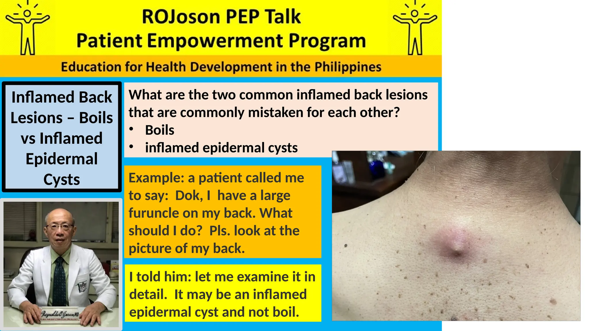 ROJoson PEP Talk: Inflamed Back Lesions: Boils vs Inflamed Epidermal ...