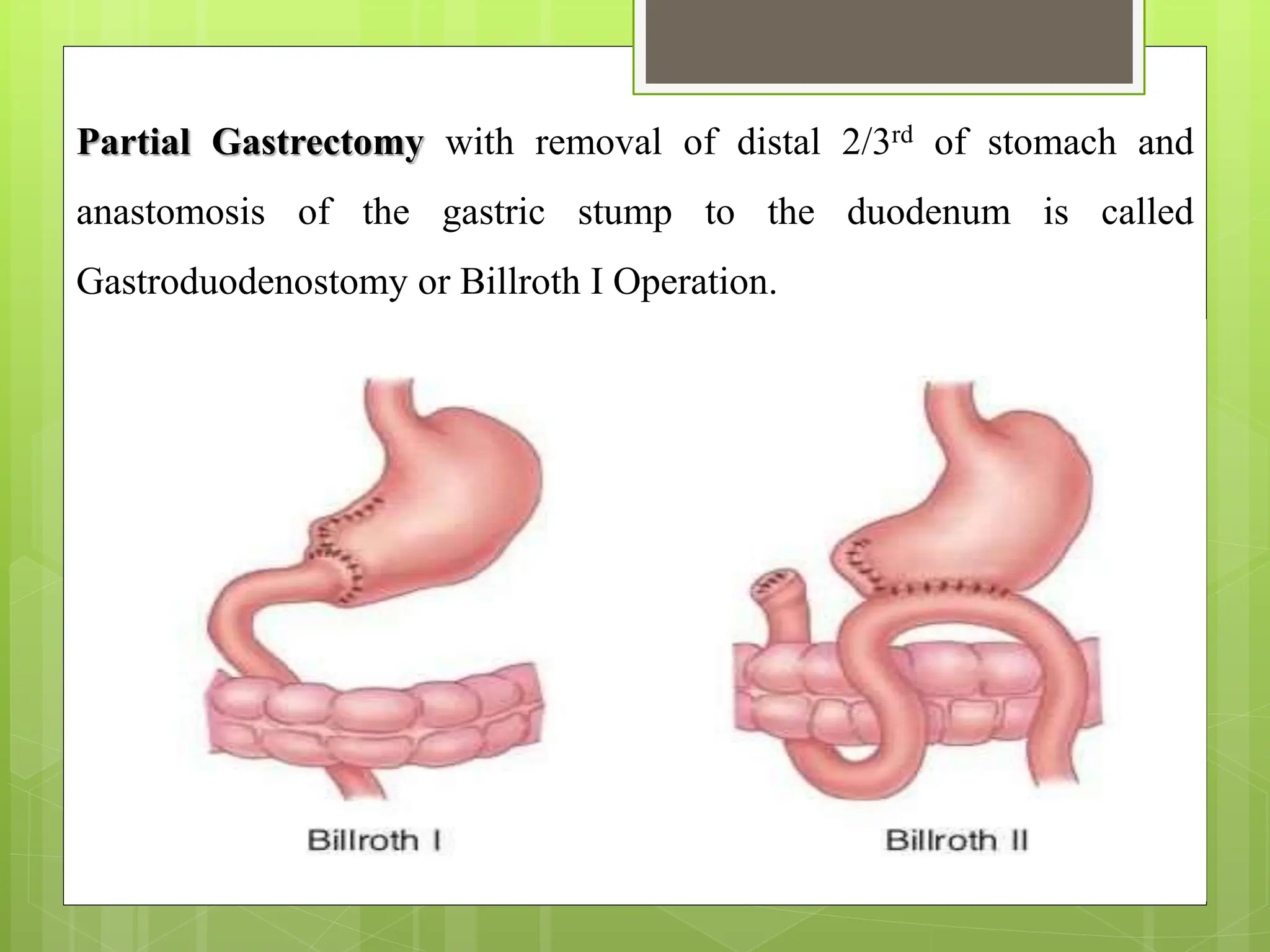 Peptic & Duodenal Ulcer.pptx