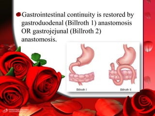 Peptic ulcer | PPTX