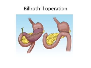 Billroth ll operation
 