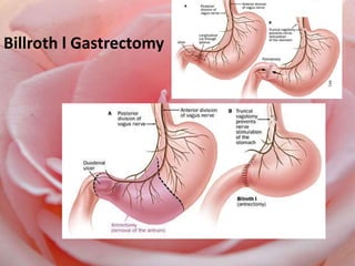 Billroth l Gastrectomy
 